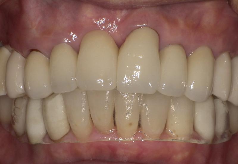 アライナー装着時（正面）