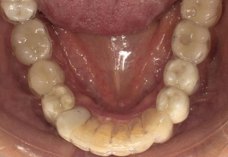 アライナー装着時（下顎）