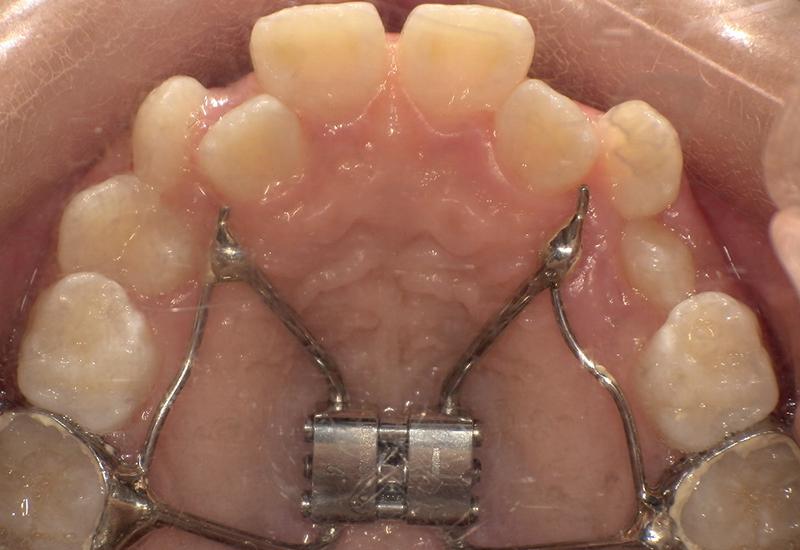 治療中（下顎）